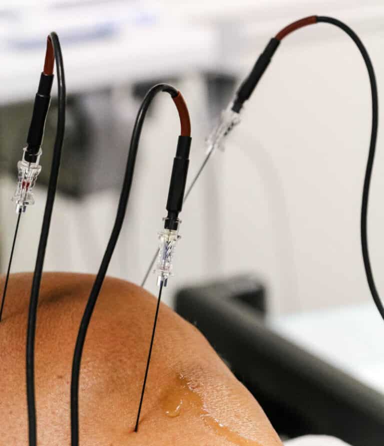 Radio Frequency Ablation (RFA) In Somerset County NJ Performance