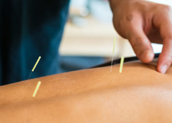 Benefits of Acupuncture Along With Physical Therapy