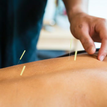 Benefits of Acupuncture Along With Physical Therapy