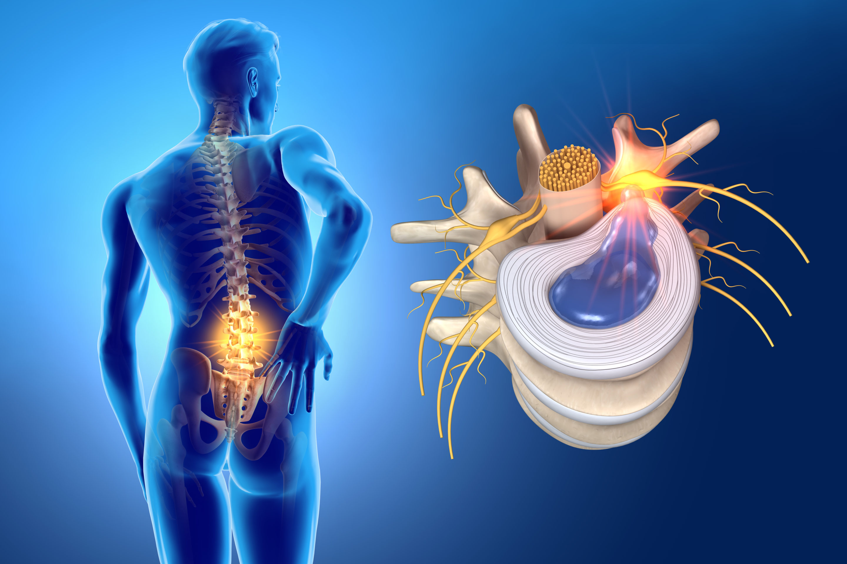 Key Differences Between a Herniated and Bulging Disc a sufferer in