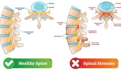 Demystifying Lumbar Spinal Stenosis: Understanding Your Back Pain