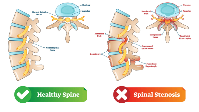 Facing Spinal Stenosis With A Team-Based Approach